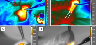 Исследования тепловых эффектов монополярной электрохирургии с помощью термографии