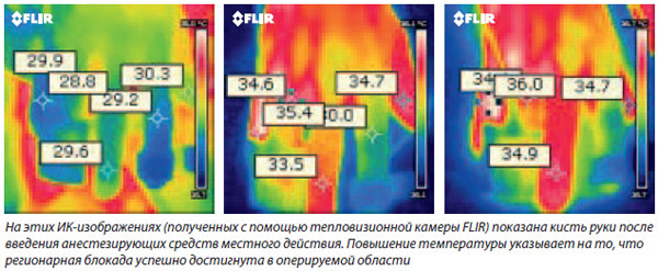 На этих ИК-изображениях (полученных с помощью тепловизионной камеры FLIR) показана кисть руки после введения анестезирующих средств местного действия. Повышение температуры указывает на то, что регионарная блокада успешно достигнута в оперируемой области