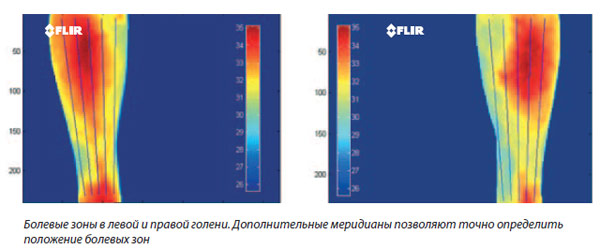 Болевые зоны в левой и правой голени. Дополнительные меридианы позволяют точно определить